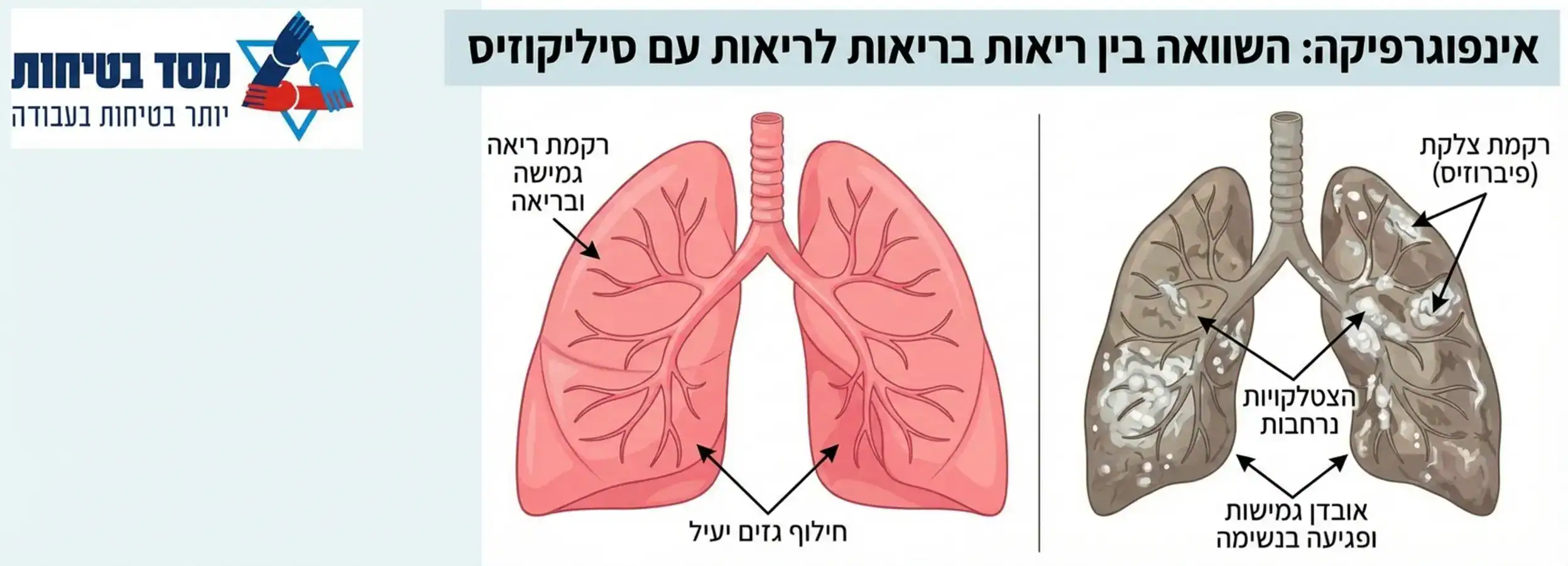 אינפוגרפיקה המציגה את ההבדל בין ריאות בריאות לבין ריאות של חולה סיליקוזיס עם הצטלקויות